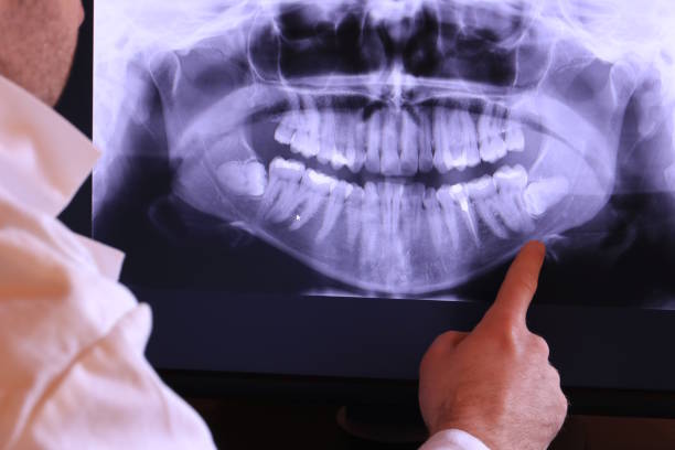 Best Emergency Treatment for Dental Infections or Abscesses in Eureka, CA